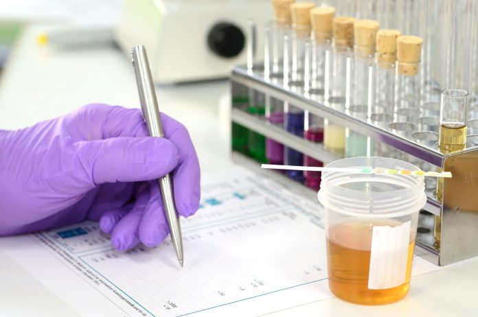 Urinprobe im Labor mit Urinteststreifen