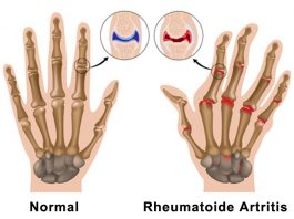 Arthrose – der langsame Gelenkverschleiß