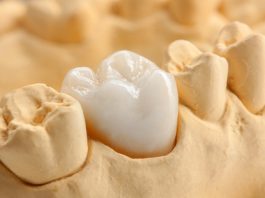 Implantat als Zahnersatz