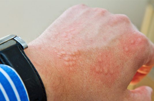 allergische Reaktion auf Mückenstich