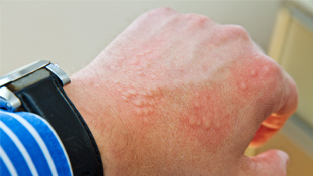 allergische Reaktion auf Mückenstich