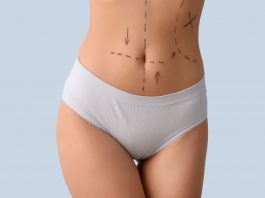Bauch einer Person mit OP-Markierungen vor einem körperformenden Eingriff wie Bauchdeckenstraffung oder ästhetischer Korrektur