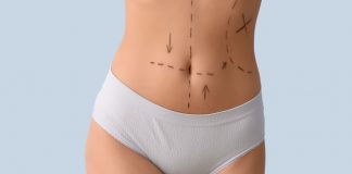 Wenn der Körper nicht mehr passt: Was körperformende Eingriffe leisten können und was nicht Bauch einer Person mit OP-Markierungen vor einem körperformenden Eingriff wie Bauchdeckenstraffung oder ästhetischer Korrektur