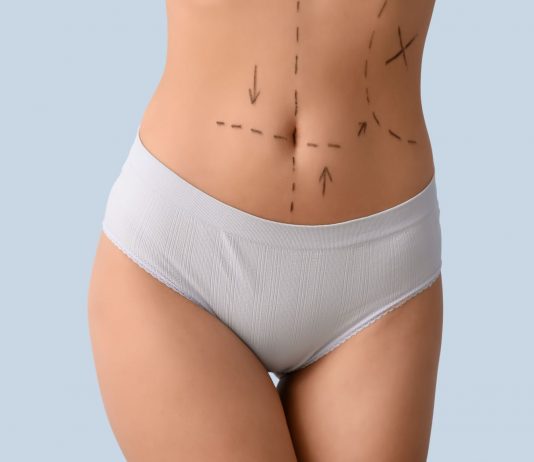 Wenn der Körper nicht mehr passt: Was körperformende Eingriffe leisten können und was nicht Bauch einer Person mit OP-Markierungen vor einem körperformenden Eingriff wie Bauchdeckenstraffung oder ästhetischer Korrektur