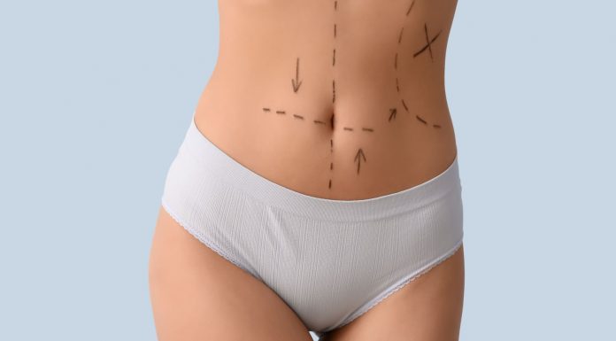 Wenn der Körper nicht mehr passt: Was körperformende Eingriffe leisten können und was nicht Bauch einer Person mit OP-Markierungen vor einem körperformenden Eingriff wie Bauchdeckenstraffung oder ästhetischer Korrektur