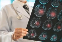 Die Folgen von subduralen Hämatomen: Sind sie umkehrbar? Ärztliche Person hält eine MRT-Aufnahme des Gehirns, auf der mehrere rot markierte Bereiche mögliche Blutungen oder Verletzungsherde anzeigen. Die Darstellung verdeutlicht neurologische Schäden im Gehirn.