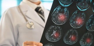 Ärztliche Person hält eine MRT-Aufnahme des Gehirns, auf der mehrere rot markierte Bereiche mögliche Blutungen oder Verletzungsherde anzeigen. Die Darstellung verdeutlicht neurologische Schäden im Gehirn.