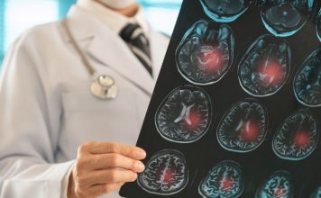 Ärztliche Person hält eine MRT-Aufnahme des Gehirns, auf der mehrere rot markierte Bereiche mögliche Blutungen oder Verletzungsherde anzeigen. Die Darstellung verdeutlicht neurologische Schäden im Gehirn.