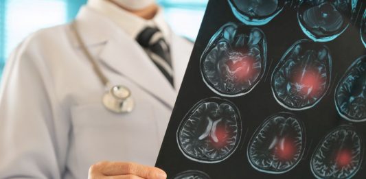 Die Folgen von subduralen Hämatomen: Sind sie umkehrbar? Ärztliche Person hält eine MRT-Aufnahme des Gehirns, auf der mehrere rot markierte Bereiche mögliche Blutungen oder Verletzungsherde anzeigen. Die Darstellung verdeutlicht neurologische Schäden im Gehirn.