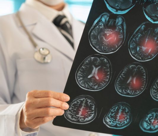 Ärztliche Person hält eine MRT-Aufnahme des Gehirns, auf der mehrere rot markierte Bereiche mögliche Blutungen oder Verletzungsherde anzeigen. Die Darstellung verdeutlicht neurologische Schäden im Gehirn.