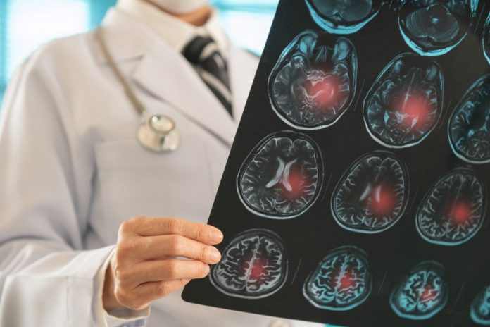 subdurales-haematom-folgen Ärztliche Person hält eine MRT-Aufnahme des Gehirns, auf der mehrere rot markierte Bereiche mögliche Blutungen oder Verletzungsherde anzeigen. Die Darstellung verdeutlicht neurologische Schäden im Gehirn.