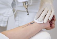 Tattooentfernung mit Lasergerät an einem Unterarm, durchgeführt von Fachpersonal mit Handschuhen – roter Lichtpunkt zeigt präzise Anwendung der Lasertechnologie.