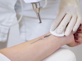 Tattooentfernung mit Lasergerät an einem Unterarm, durchgeführt von Fachpersonal mit Handschuhen – roter Lichtpunkt zeigt präzise Anwendung der Lasertechnologie.