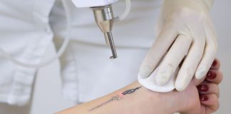 Tattooentfernung mit Lasergerät an einem Unterarm, durchgeführt von Fachpersonal mit Handschuhen – roter Lichtpunkt zeigt präzise Anwendung der Lasertechnologie.