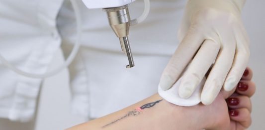 Tattooentfernung mit Lasergerät an einem Unterarm, durchgeführt von Fachpersonal mit Handschuhen – roter Lichtpunkt zeigt präzise Anwendung der Lasertechnologie.