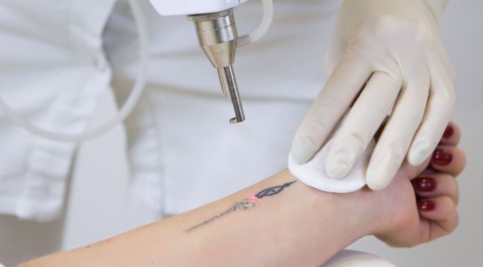 Tattooentfernung mit Lasergerät an einem Unterarm, durchgeführt von Fachpersonal mit Handschuhen – roter Lichtpunkt zeigt präzise Anwendung der Lasertechnologie.