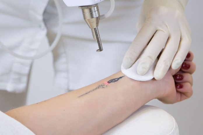 tattooentfernung_zurueck_zu_natuerlicher_haut Tattooentfernung mit Lasergerät an einem Unterarm, durchgeführt von Fachpersonal mit Handschuhen – roter Lichtpunkt zeigt präzise Anwendung der Lasertechnologie.